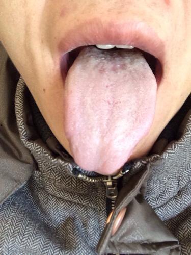 吃瓜舌苔白厚,揭秘吃瓜背后的健康密码